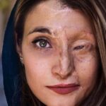 הפנים של אומץ: הצעירה האיראנית שהפכה את פניה השרופות לסמל מאבק