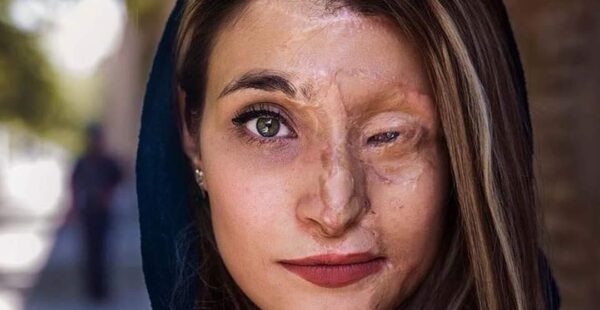 הפנים של אומץ: הצעירה האיראנית שהפכה את פניה השרופות לסמל מאבק