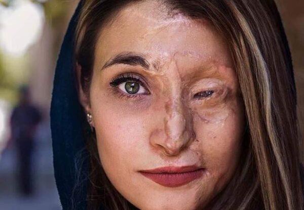 הפנים של אומץ: הצעירה האיראנית שהפכה את פניה השרופות לסמל מאבק