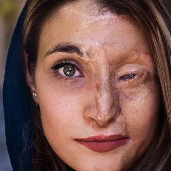 הפנים של אומץ: הצעירה האיראנית שהפכה את פניה השרופות לסמל מאבק